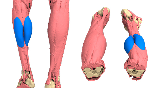 Reconstitution 3D de l'atrophie du mollet du patient avec design 3D de l'implant sur-mesure