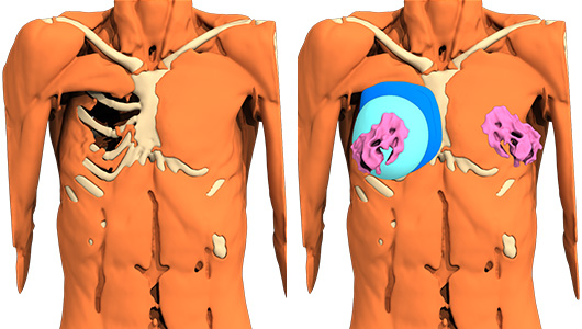 Reconstitution 3D du syndrome de Poland de la patiente et design 3D de l'implant sur-mesure