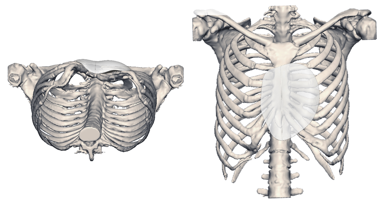 3D images of the patient's skeleton with the 3D implant
