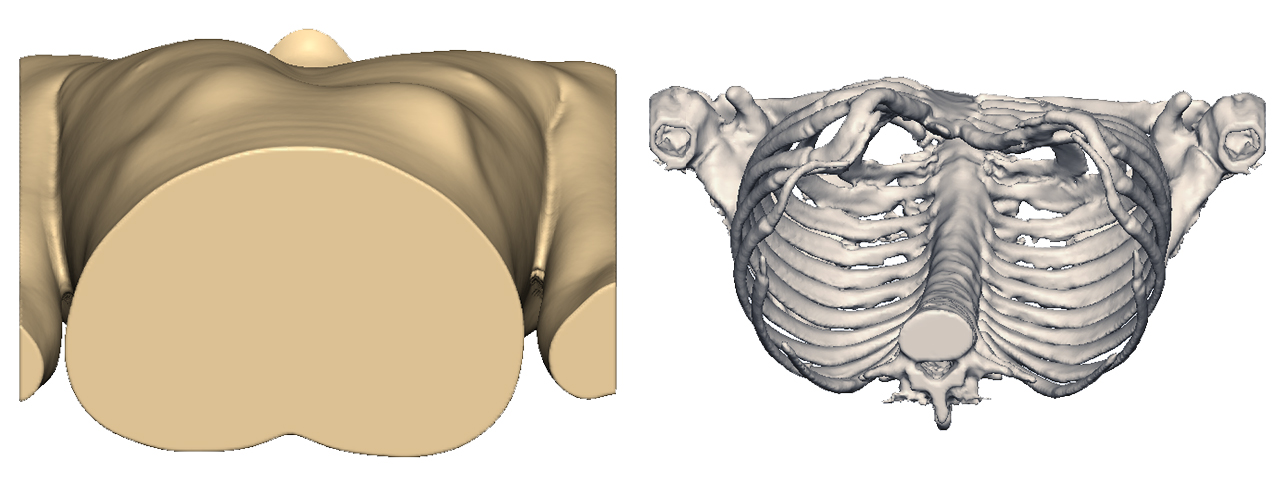 3D design of the patient's body showing its pectus