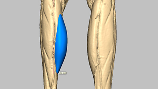 Vista 3D dell'impianto personalizzato per correggere l'atrofia del polpaccio