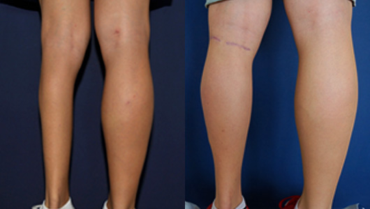Vue de dos avant et après une chirurgie de l'atrophie du mollet