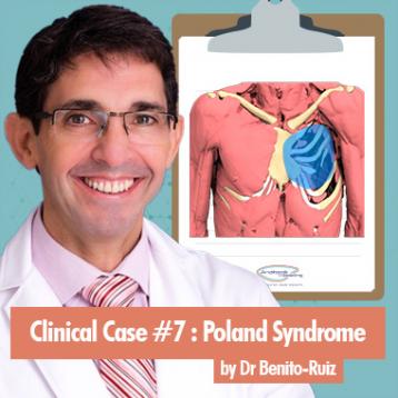 Caso clinico: trattamento di una sindrome di Poland pronunciata da parte del Dott. Benito-Ruiz