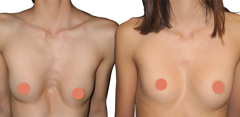 Esempi di torace infossato femminile