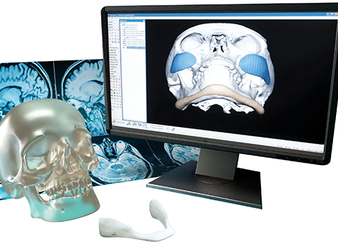 Implant de menton Implantech Implant de menton Implantech