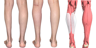 Man's before/after calf artophy treatment with 3D implants Before/after calf artophy treatment with 3D implants