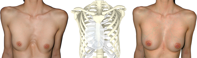 Before/after photo of a woman's pectus treated with a 3D implant