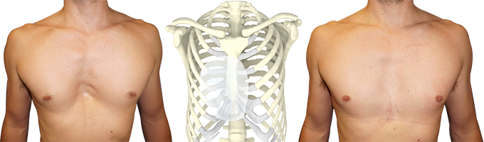 Before/after photo of a man's pectus treated with a 3D implant