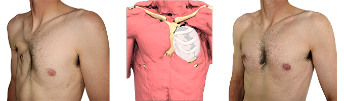 Before/after photo of Poland syndrome treated with 3D implant