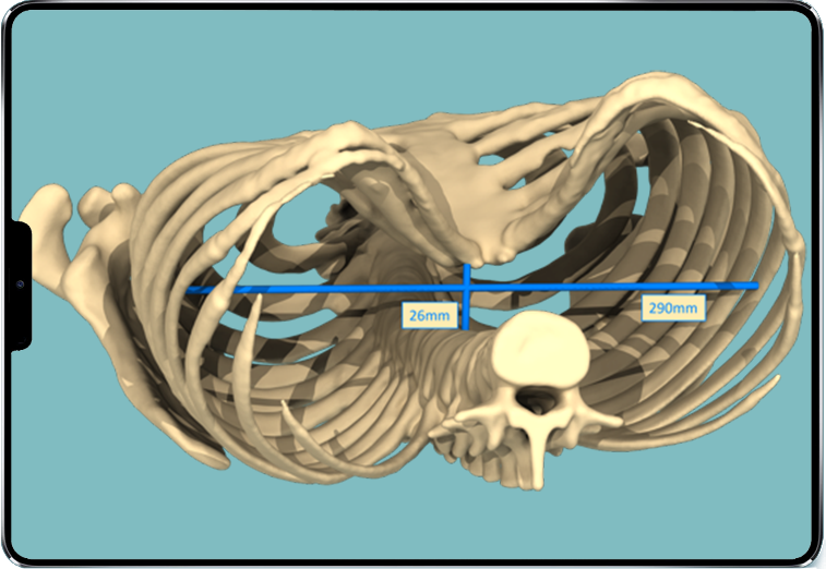 Haller index calculation Digital image of a Haller index calculation on a funnel chest
