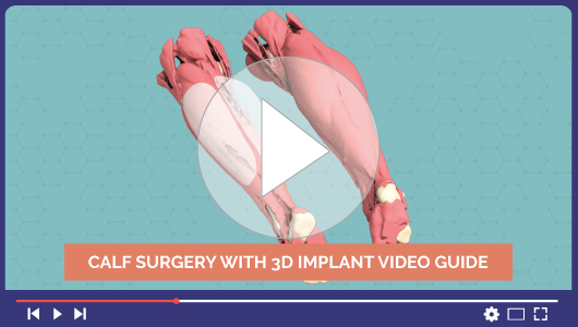 Video dell'intervento chirurgico per l'atrofia del polpaccio con un impianto 3D personalizzato