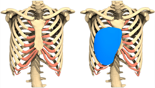 Vista 3D del implante para un Pectus Excavatum