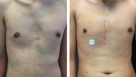 Ergebnis vor und nach dem Einsetzen des Pectus-Implantats
