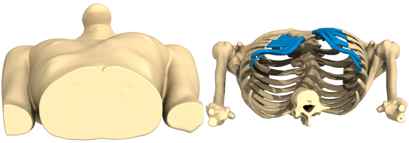 Vista 3D de una depresión lateral derecha debido a un Pectus Excavatum