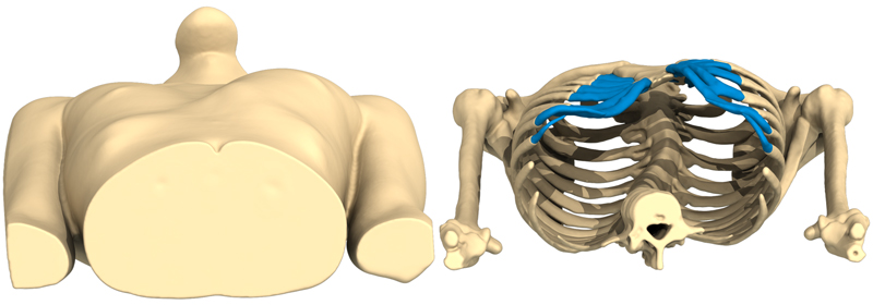 Vista 3D di un Pectus Excavatum laterale profondo