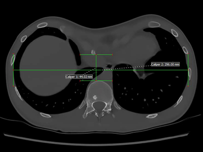 Scan del tórax que muestra un índice de Haller de 6.7