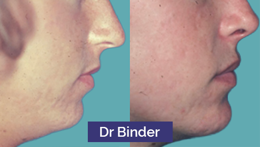 Avant après chirurgie du menton et du nez par le Dr William Binder, chirurgien esthétique américain Photo avant après chirurgie du menton et du nez par le Dr William Binder, chirurgien esthétique américain