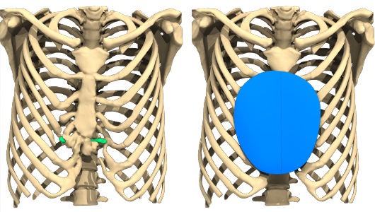 Imágenes del implante en desfile creado por AnatomikModeling