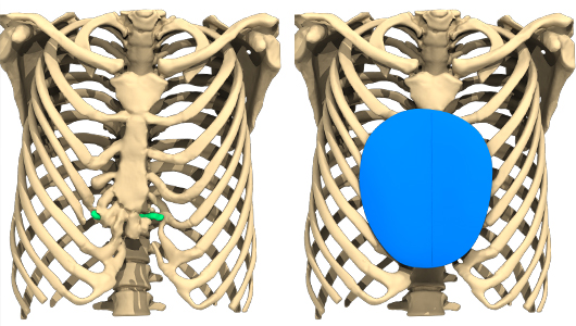 Images Demonstrating the rendered pectus implant created by Anatomik Modeling