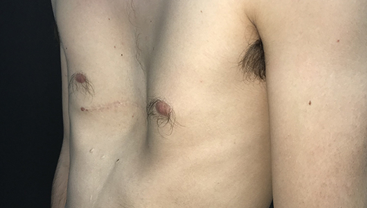 Photos post modified Ravitch (notified by the scar) procedure with a residual pectus excavatum