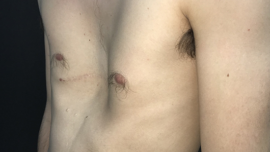 Photo post-opératoire de la technique de Ravitch (symbolisée par la cicatrice) avec un pectus excavatum résiduel