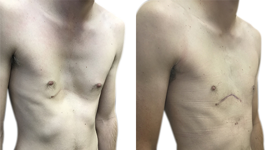 Photo du Pectus Excavatum traité avec implant 3D sur-mesure