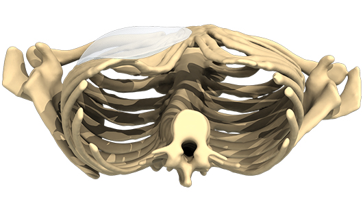 low angle view of a 3D design of the implant to treat Pectus Excavatum low angle view of a 3D design of the implant to treat Pectus Excavatum