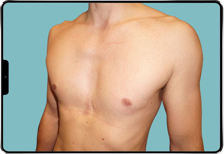 Image d'un Pectus Excavatum profond d'homme traité par implant 3D sur-mesure Image d'un Pectus Excavatum profond d'homme traité par implant 3D sur-mesure