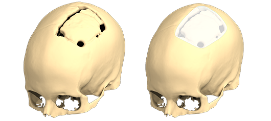 Imagen de antes y después de una craneoplastia para corregir una deformidad del cráneo