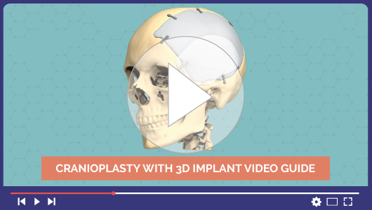 Video di cranioplastica con impianti 3D personalizzati