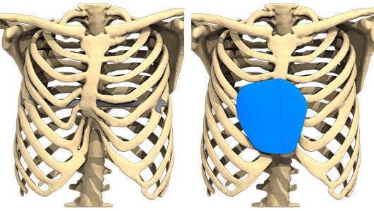 Preoperative planning images studied on the computer of the reconstruction with a 3D custom-made implant