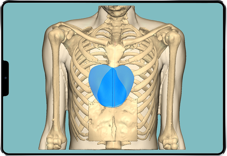 design 3D de l'implant sur-mesure Image du design 3D de l'implant sur-mesure