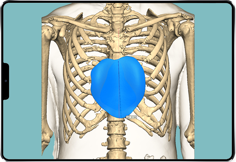 design 3D de l'implant sur-mesure chez un homme Image du design 3D de l'implant sur-mesure chez un homme