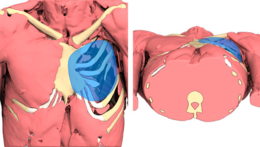 Design des maßgeschneiderten 3D-Implantats für die Korrektur des Poland-Syndroms