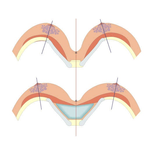 Dessin d'asymétrie mammaire causé par Pectus Excavatum avec légère convergence