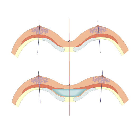 How Common Is Breast Asymmetry? – Symmetrista