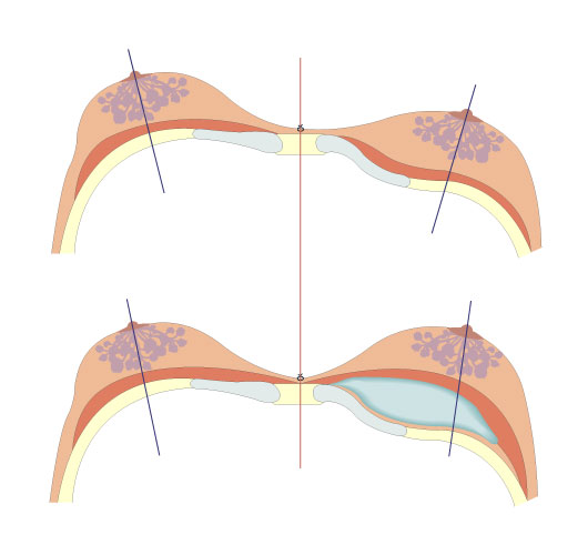 Breast asymmetry pattern caused by Pectus Excavatum with strong asymmetry