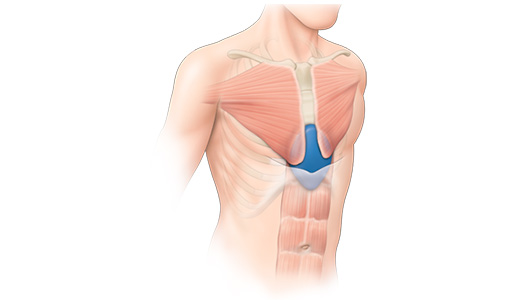 Drawing of an implant filling a Pectus Excavatum hole