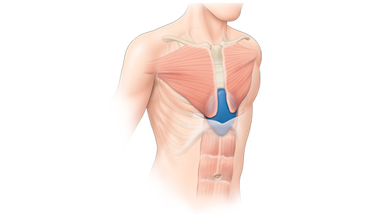 Dessin d'un implant comblant un Pectus Excavatum