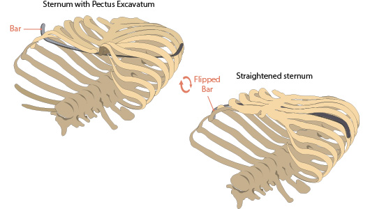 Drawing of the Nuss technique surgery with flipped bars