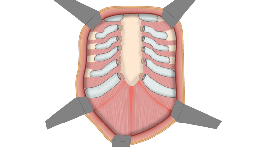 Disegno dell'operazione tecnica Ravitch