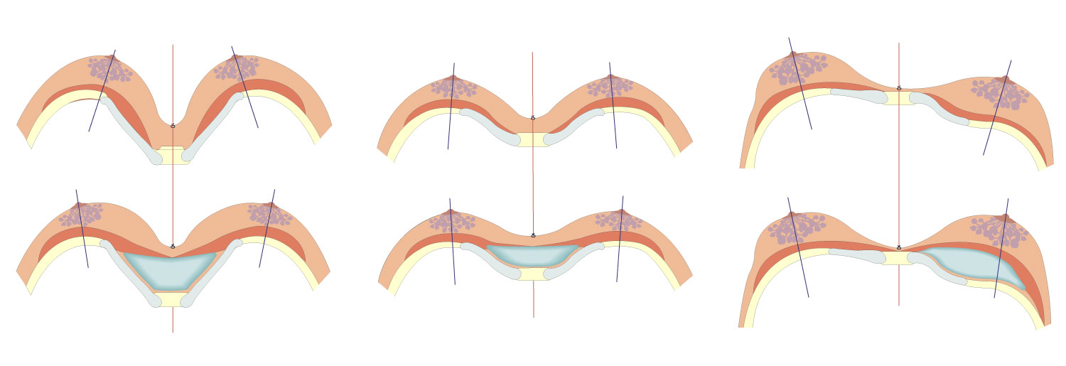 Disegni dell'effetto degli impianti 3D su misura su diversi tipi di seno