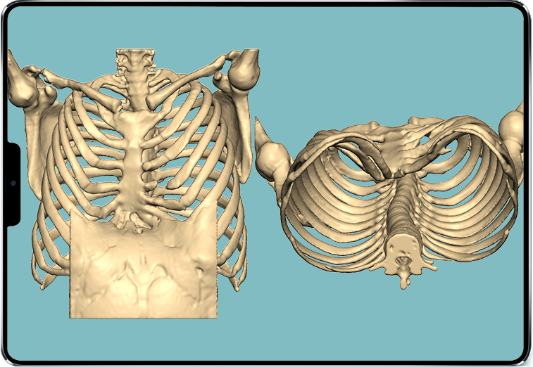3D-Ansicht der Trichterbrust am Skelett des Patienten 3D-Ansicht der Trichterbrust am Skelett des Patienten