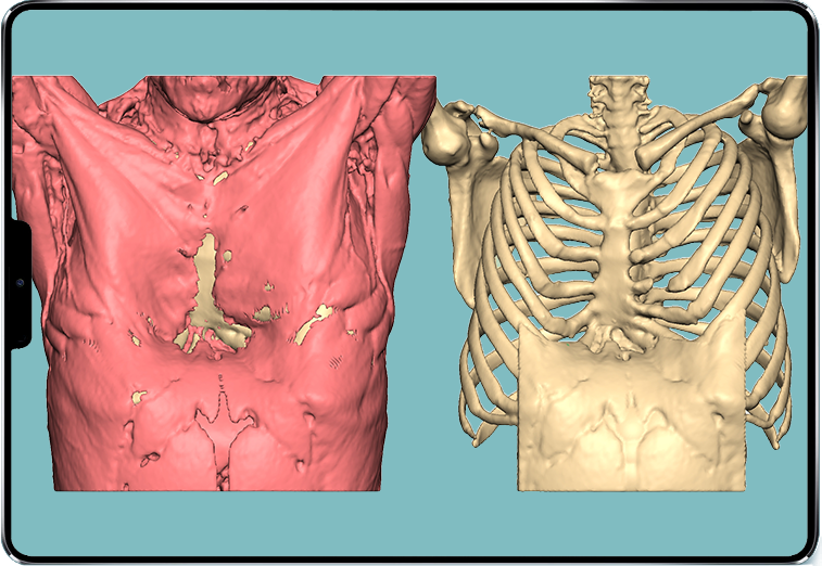 3D-Bilder eines Pectus arcuatum bei einem männlichen Patienten 3D-Bilder eines Pectus arcuatum bei einem männlichen Patienten