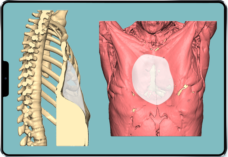 3D-Ansicht der 3D-Implantattechnik für Pectus arcuatum von Dr. Chadi Murr 3D-Ansicht der 3D-Implantattechnik für Pectus arcuatum von Dr. Chadi Murr