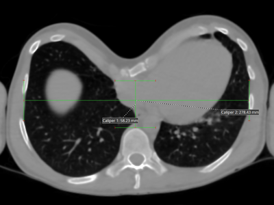 Illustration of the calculation of the Haller index of a Pectus
