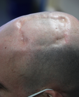 Immagine di una deformazione del cranio visibile sotto la pelle