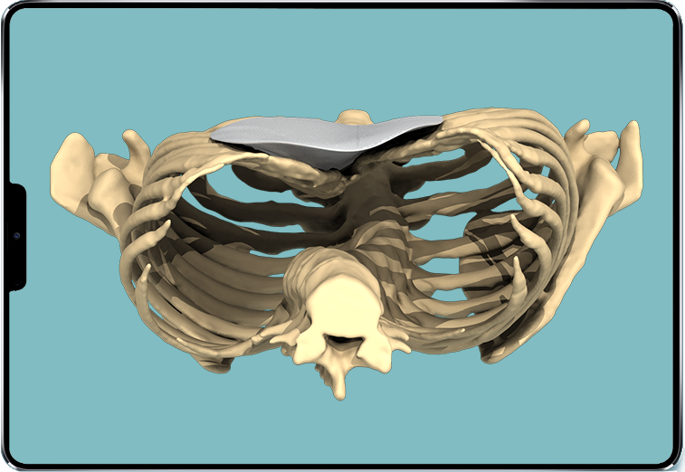 Bild eines 3D-Designs zur Auffüllung einer Trichterbrust mit einem maßgefertigten 3D-Implantat
