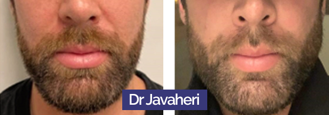 Photo de masculinisation du visage par le dr Barry Eppley, chirurgien esthétique américain
