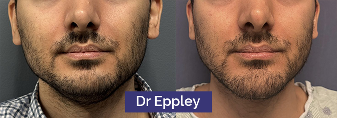 Masculinisation du visage par le dr Barry Eppley, chirurgien esthétique américain Photo de masculinisation du visage par le dr Barry Eppley, chirurgien esthétique américain